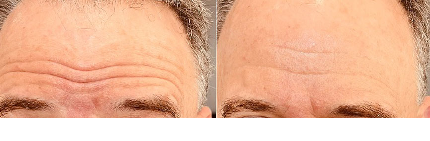 Botox-Male-Forhead-In-Office-Before-and-After