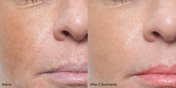 Microneedling-before-and-after