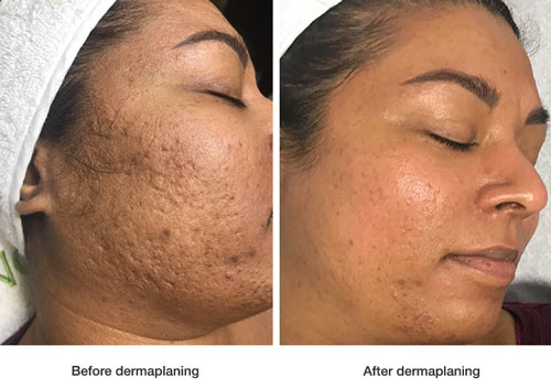before-and-after-dermaplaning-2-1