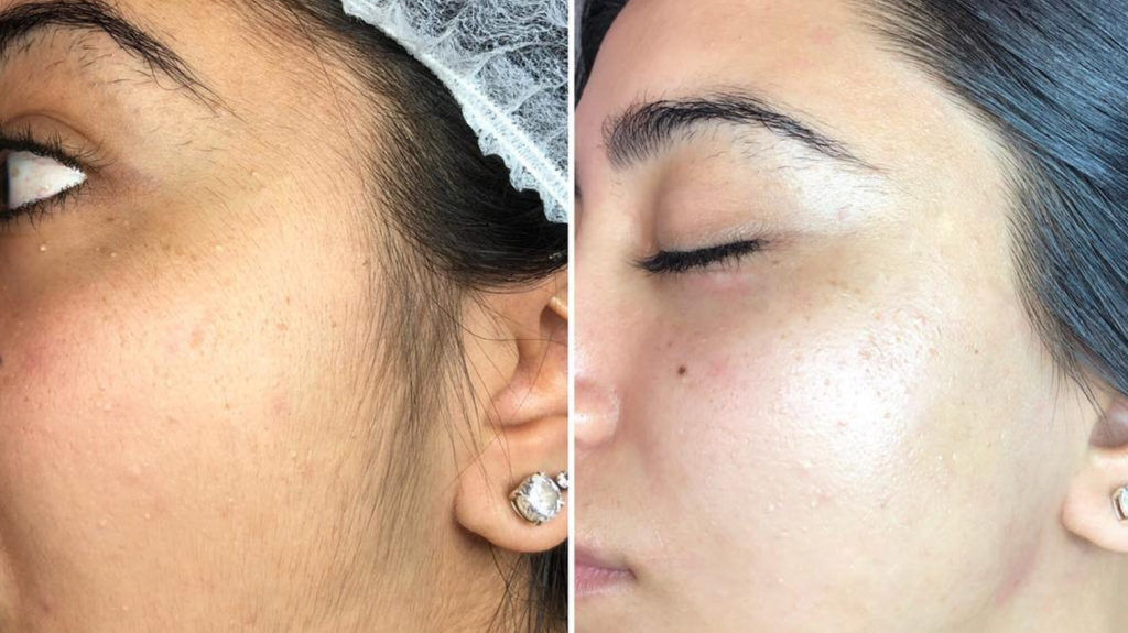 dermaplaning_before_and_after-1296x728-body_2-1024x575