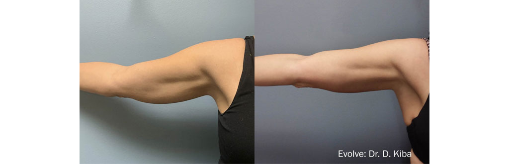 evolve-before-after-ARMS