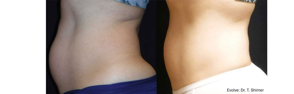 evolve-before-after-Tummy-and-Hips-1024x330