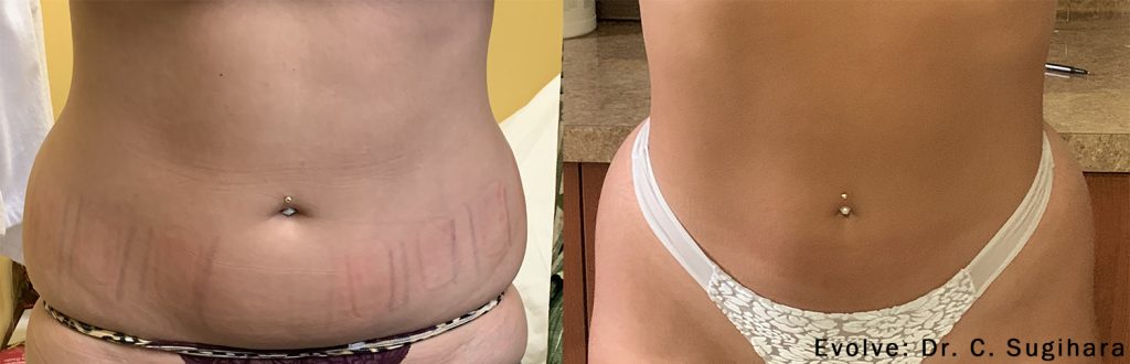 evolve-before-after-Tummy and Hips