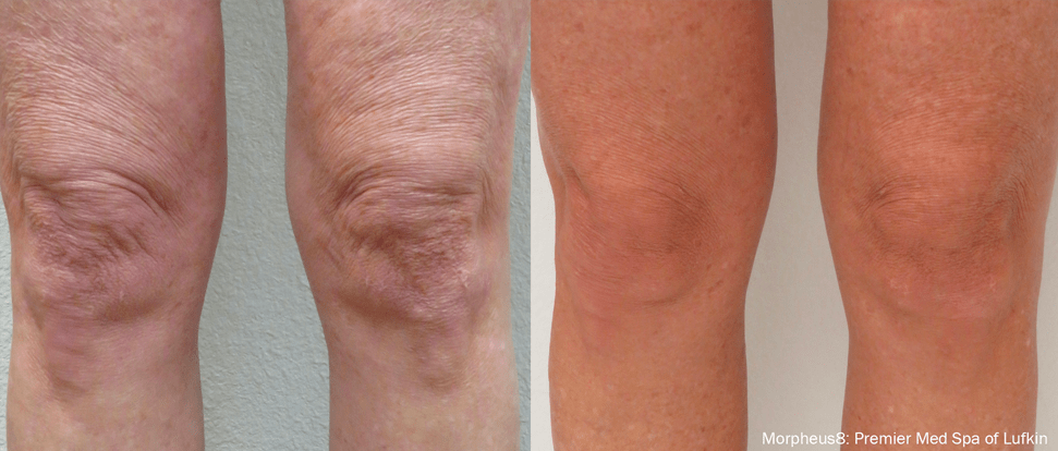 morpheus8-before-after-Knees (1)