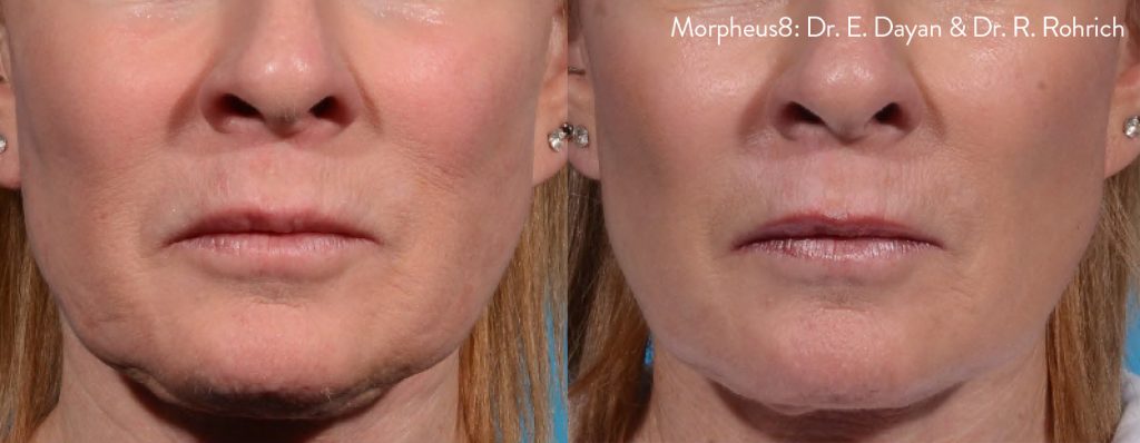 morpheus8-before-after-dr-e-dayan-dr-r-rohrich-preview-1 (1)