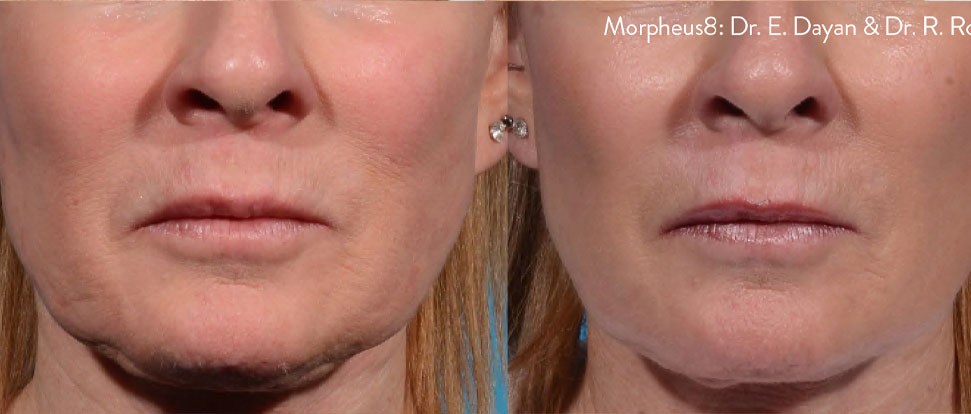morpheus8-before-after-dr-e-dayan-dr-r-rohrich-preview-1-(1)
