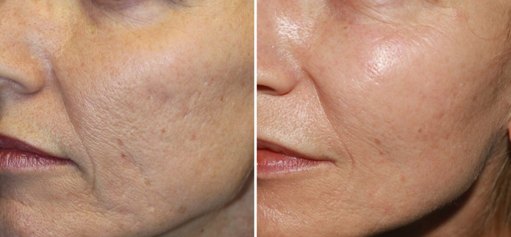 patient-14174-micro-needling-before-after-scaled