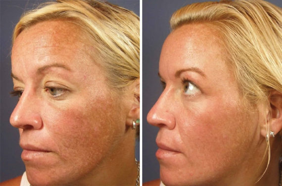 patient-8351-chemical-peels-before-after-570x376