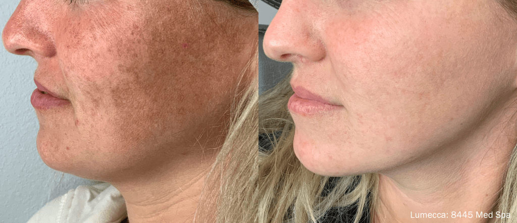 lumecca-before-after-8445-med-spa-preview-1