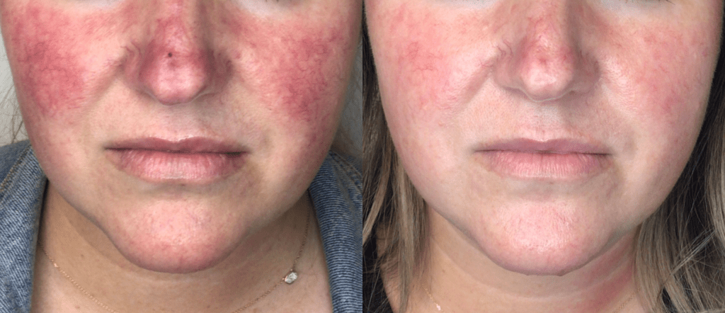 lumecca-before-after-spry-skin-and-wellness-preview-1