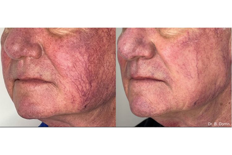 60-Year-Old-Male-Vascular-IPL-Face