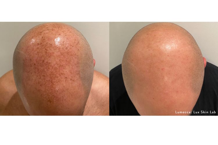 Lumecca-before-and-after-bald