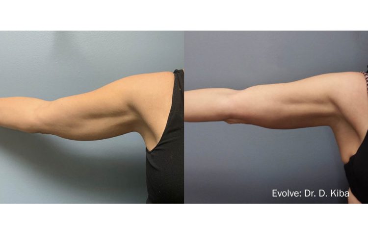 evolve-before-after-ARMS